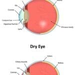 Correct Dry Eye Syndrome at LIberty Laser Eye Center