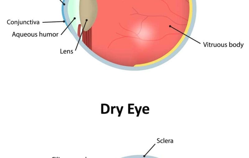 Correct Dry Eye Syndrome at LIberty Laser Eye Center