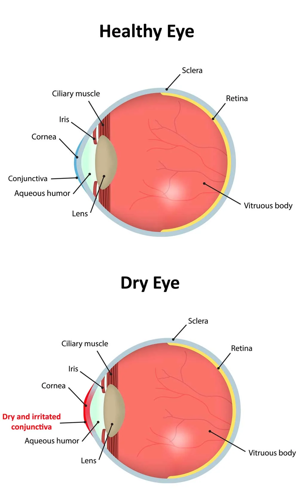 Correct Dry Eye Syndrome at LIberty Laser Eye Center