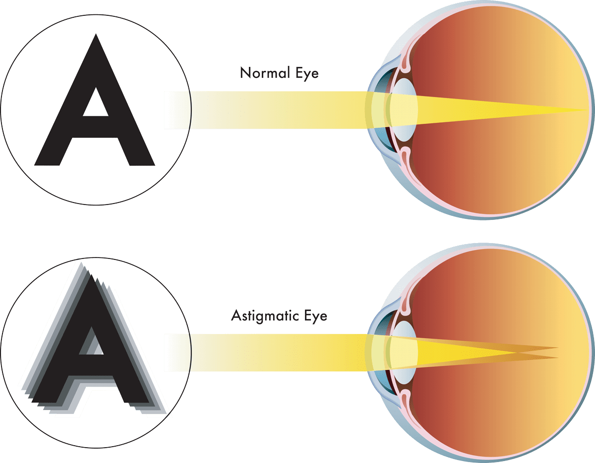 Correct Astigmatism at Liberty Laser Eye Center in the DC Metro Area