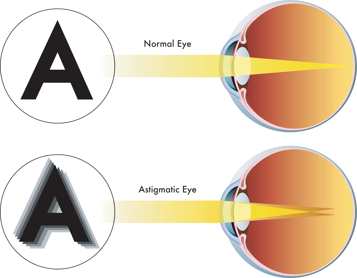 Correct Astigmatism at Liberty Laser Eye Center in the DC Metro Area
