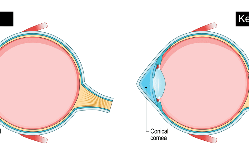 Correct Keratoconus at Liberty Laser Eye Center