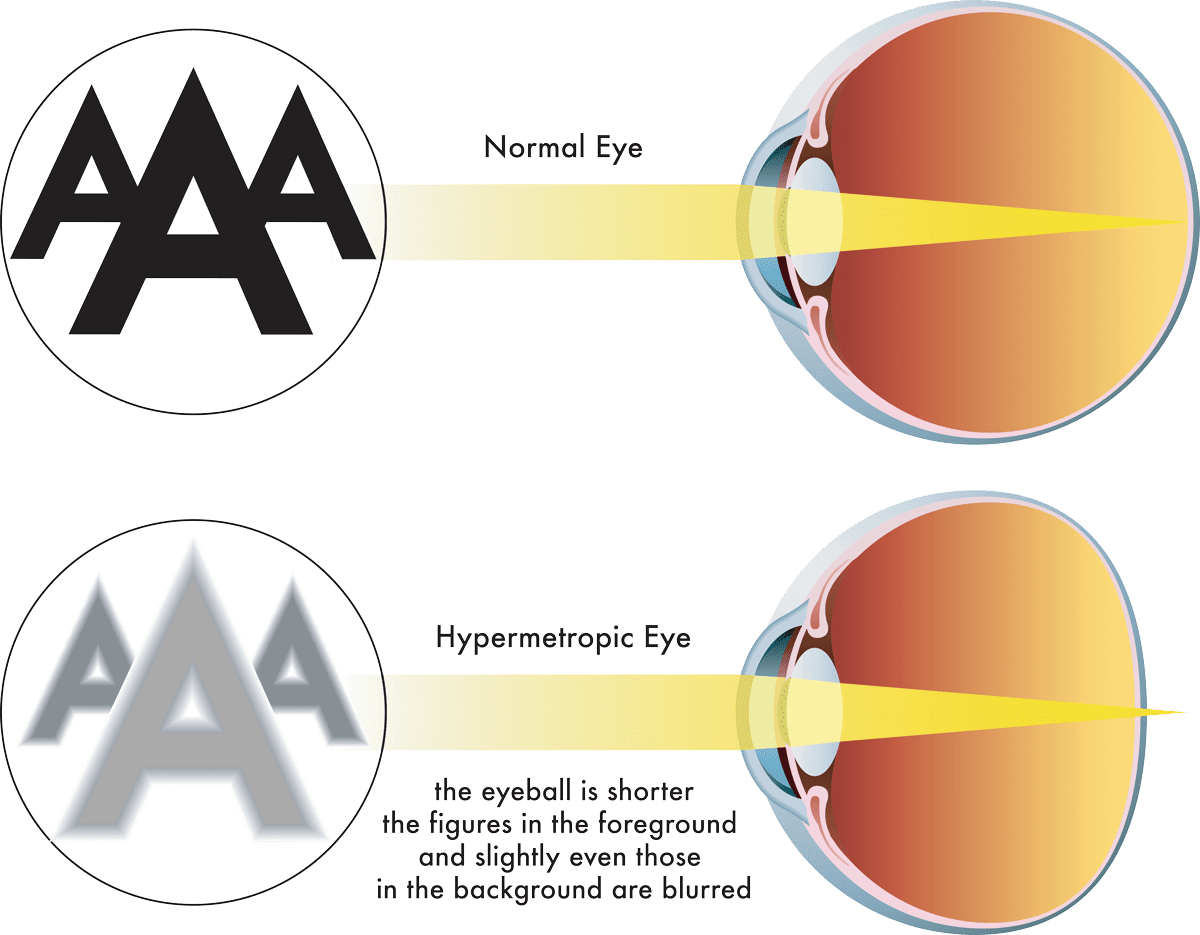 Correct Farsightedness at Liberty Laser Eye Serving the DC Metro Area