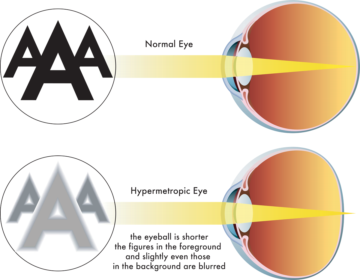 Correct Farsightedness at Liberty Laser Eye Serving the DC Metro Area