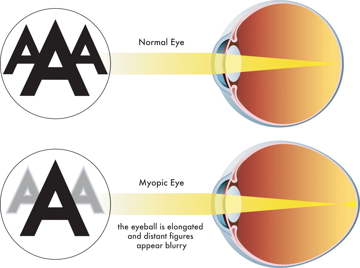 Correct Nearsightedness and Myopia at Liberty Laser Eye Center in the DC Metro Area